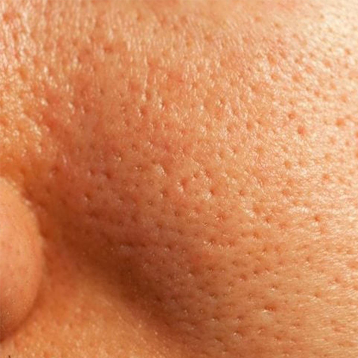 Enlarged or Open Pores
