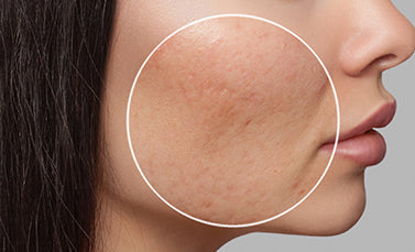 HOW TO GET RID OF ACNE SCARS