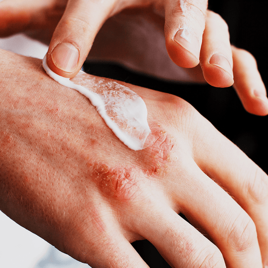 WHAT IS ECZEMA, HOW CAN I TREAT IT?