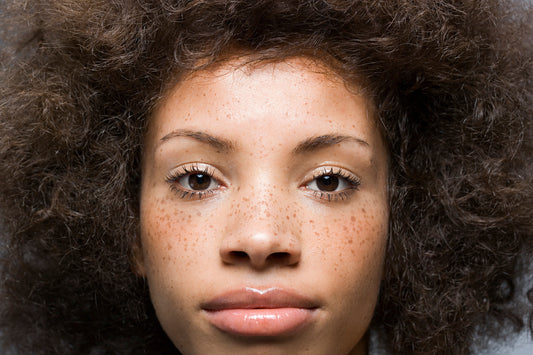 WHAT IS HYPERPIGMENTATION AND HOW SHOULD I TREAT IT?