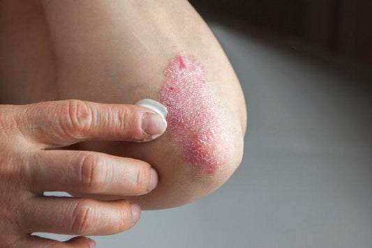 WHAT IS PSORIASIS AND HOW CAN I TREAT IT?