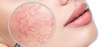 UNDERSTANDING ROSACEA CAUSES, TRIGGERS - PART 2