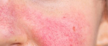 THE KEY FOR MANAGING ROSACEA - PART 3