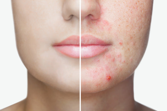 WHAT CAUSES ACNE AND HOW CAN I TREAT IT?