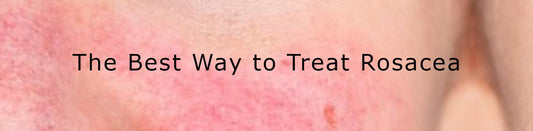 THE BEST WAY TO TREAT ROSACEA - PART 4