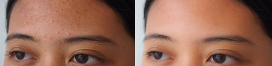 HOW TO ADDRESS DIFFERENT TYPES OF ACNE