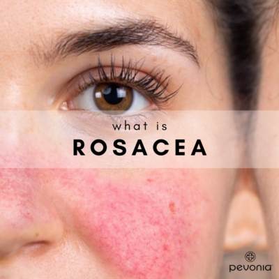 WHAT IS ROSACEA?