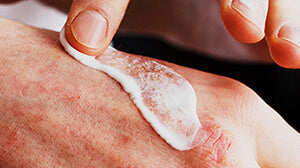 WHAT IS ECZEMA, HOW CAN I TREAT IT?