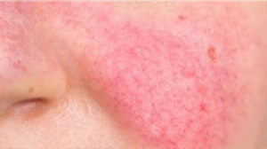 WHAT IS ROSACEA?